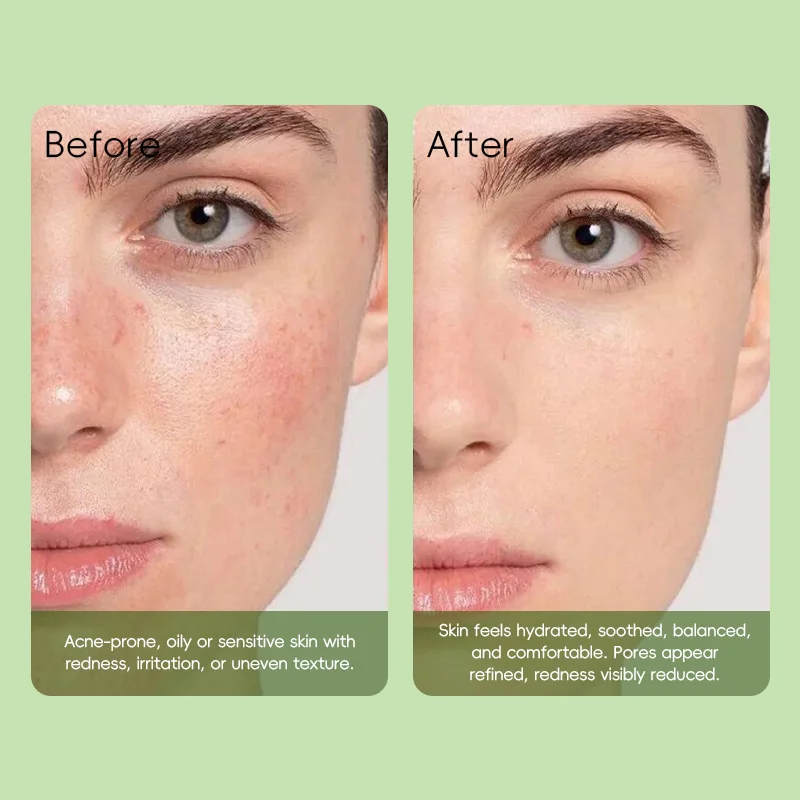 Side-by-side comparison showing skin before and after acne treatment with visible reduction in redness and inflammation.